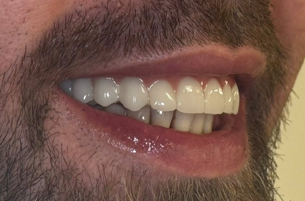 Reabilitare orală cu implanturi — Comparație — după