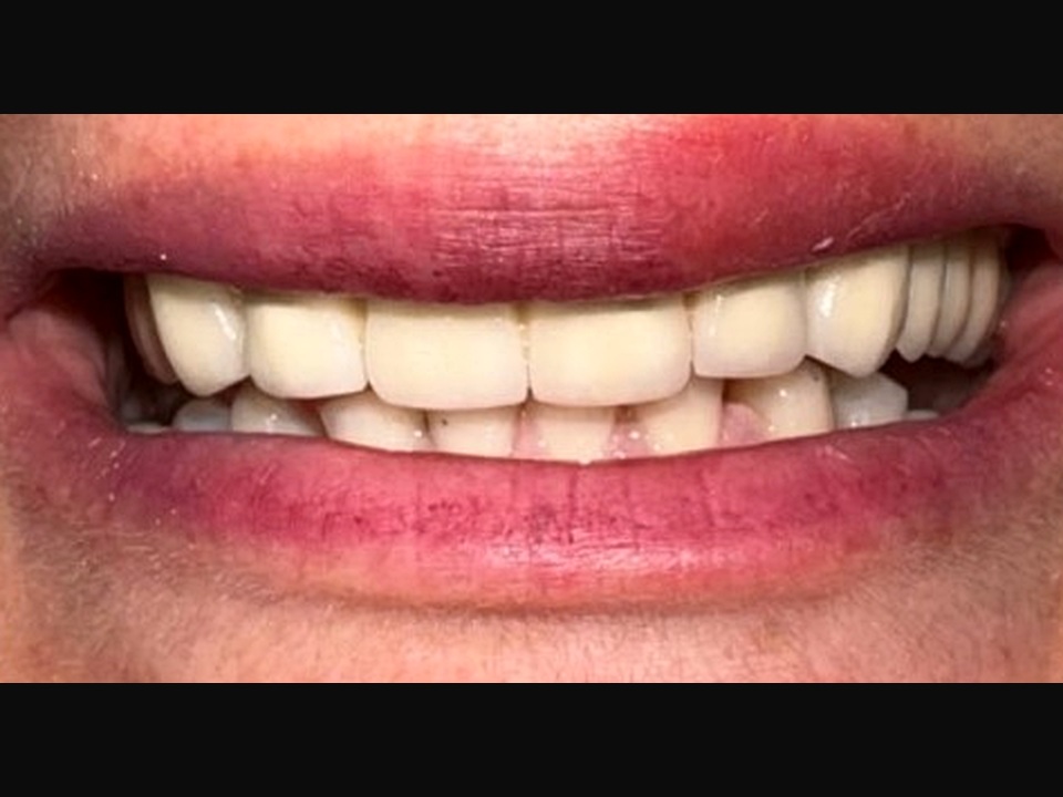 Reabilitare orală completă — Comparație — după